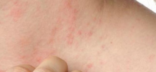 Tes alergi pada anak